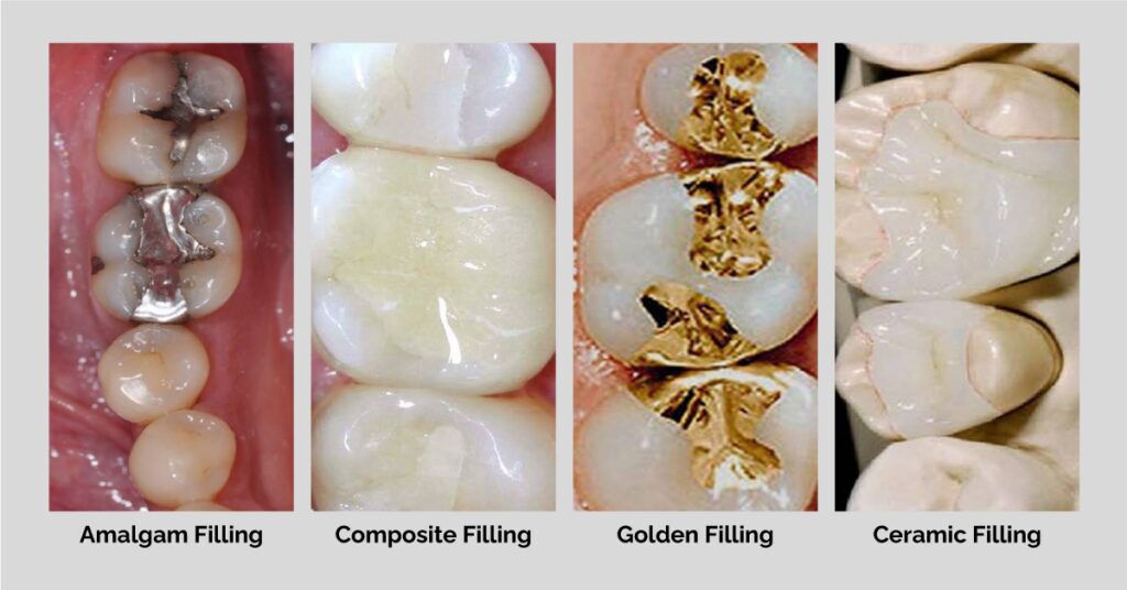 TOOTH FILLINGS IN GURGAON TREATMENT, TYPES, PROCESS & COST Dantkriti